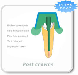 Post Crowns